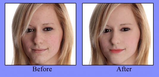 David Richardson - Pimple Removal
